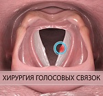 Voice restoration surgery - injection laryngoplasty for one-sided vocal cord paresis