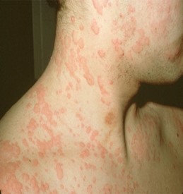 аллергия.jpg